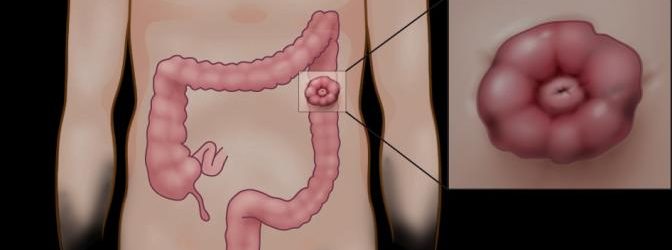 Galaxy Home Health Ostomy Care Galaxy Home Health Ostomy Care
